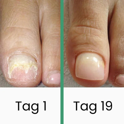 PODOclear | LLLT-Nagelpilztherapie