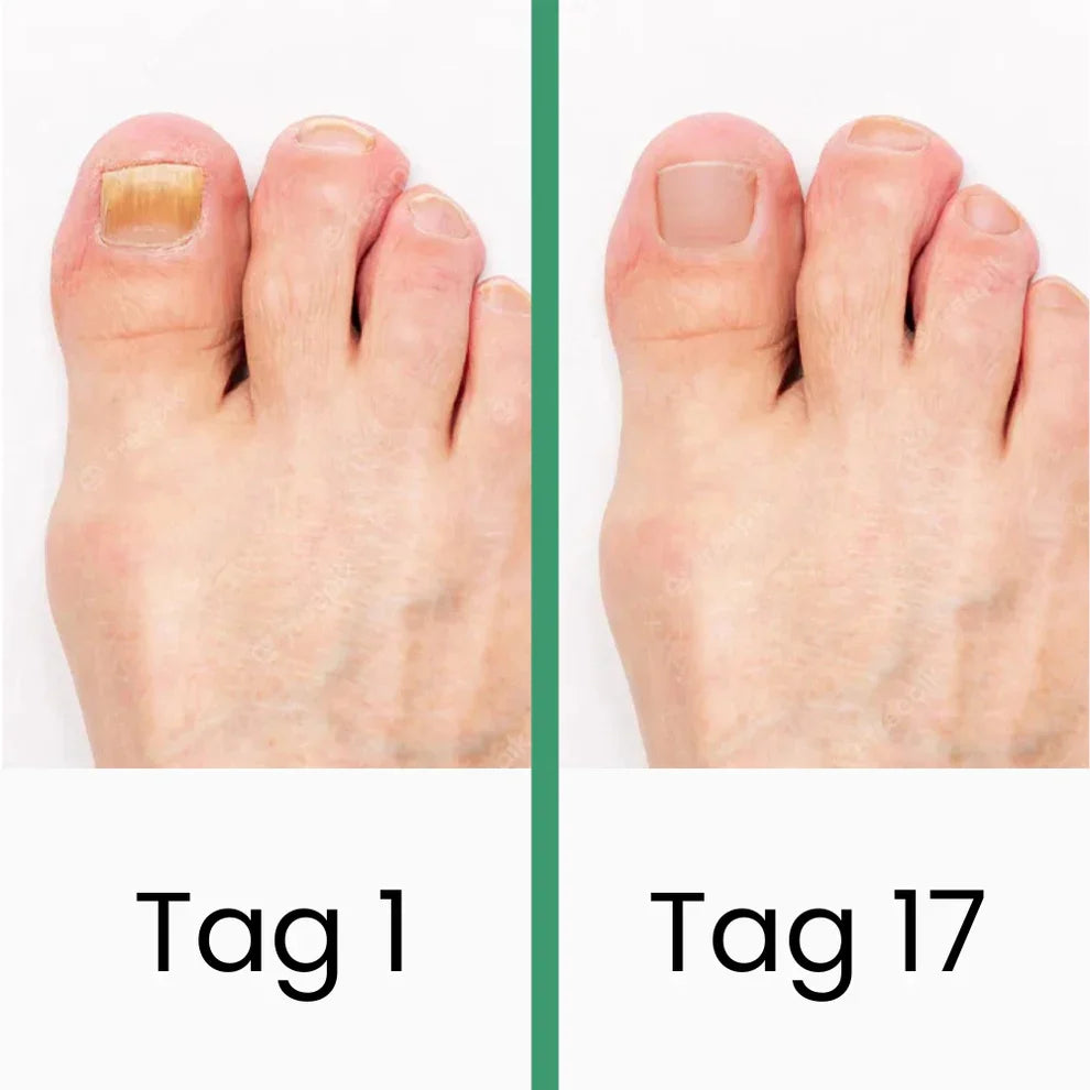 PODOclear | LLLT-Nagelpilztherapie