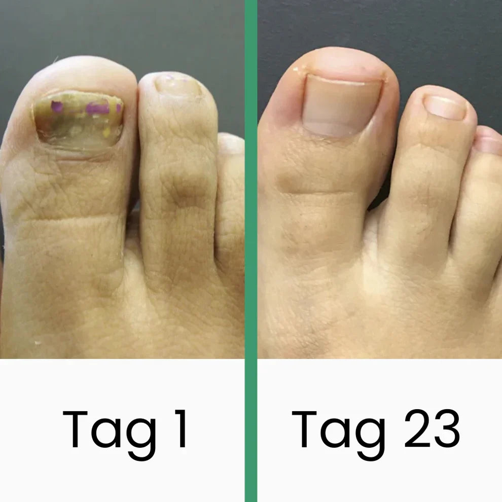 PODOclear | LLLT-Nagelpilztherapie